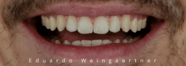 Depois do tratamento